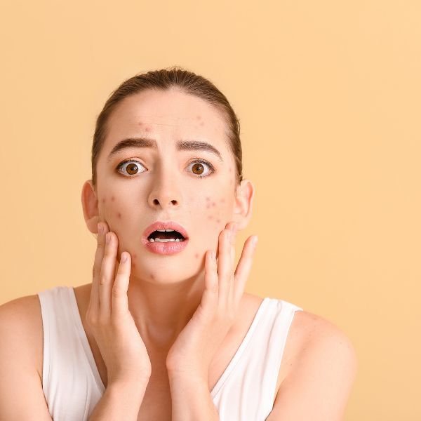 You are currently viewing Kako stres vpliva na vašo kožo